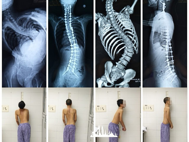 脊柱健康影响一生,脊椎骨坏死消失引起脊柱侧弯还能站