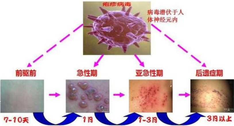 "蛇盘疮"缠一圈会要人命?
