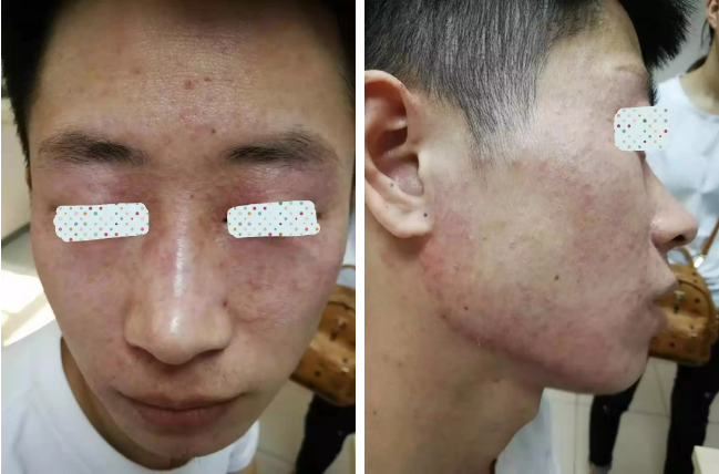 健康教育 "难辨认癣"的诊断与治疗 患者:男性  26岁 主诉:面颈部起