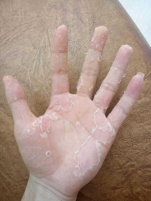 例如维生素a缺乏症,可以出现皮肤干燥和粗糙,手和脚容易出现鸡皮肤样