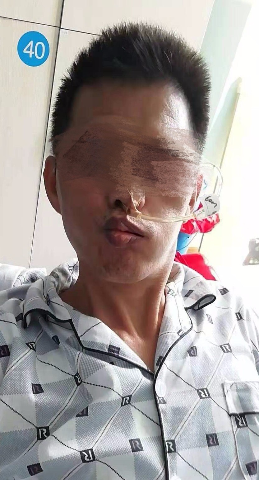 入院时嘟嘴歪斜