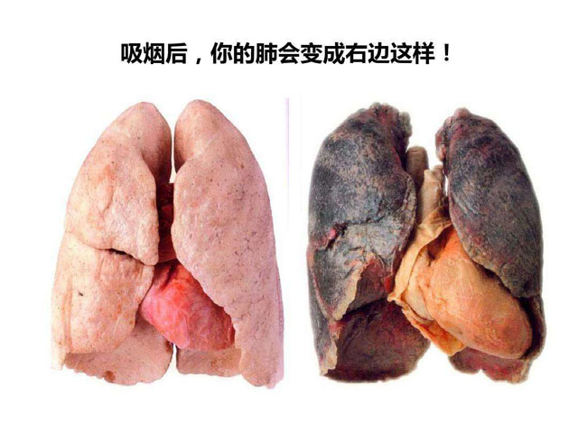 吸烟的肺真的会变黑吗?