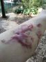 洗纹身疤痕：云南石林小伙去除手臂纹身疤痕第一次治疗恢复中记录！