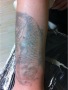 洗纹身论坛：哈尔滨美女鱼纹身遮盖13个烟头烫伤