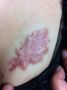 洗纹身论坛：皮肤细胞阻断再生术，去除胸口增生疤痕记录！