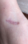 洗纹身论坛：附带小疤痕处理做个记录一次！