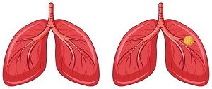 human-lungs-and-cancer-vector (1).jpg