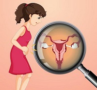 woman-with-ovarian-cancer-vector.jpg