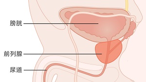 prostate-cancer-200503.jpg
