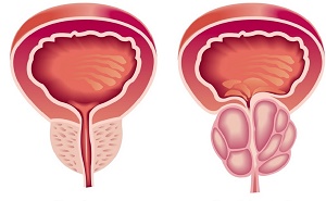 prostate-hyper2.jpg