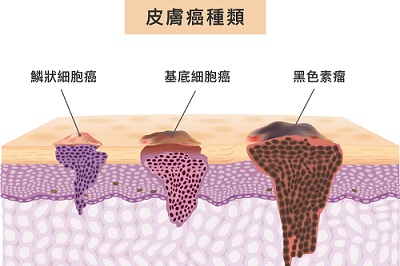 skin-cancer-type_676089217.jpg