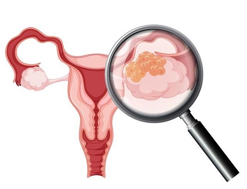 vector-ovarian-cancer-on-white-background.jpg
