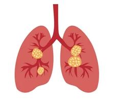 lung-cancer-flat-design-on-260nw-1888147285.jpg