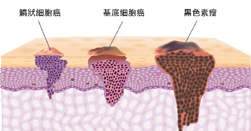 skin-cancer-type_676089217.jpg