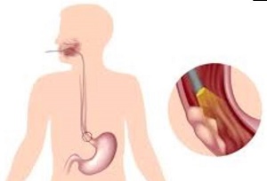 研究丨Nanvuranlat是否能改善预处理的晚期胆道癌患者生存期？