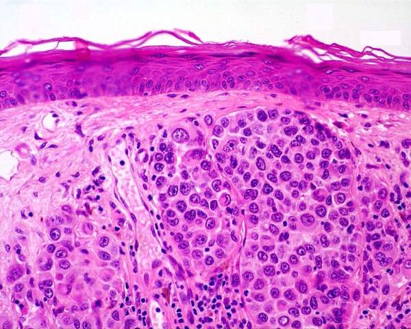 3-Melanoma.jpg