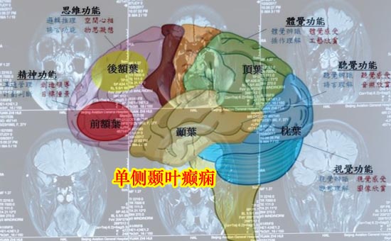 1546856417854140.jpg 1单侧颞叶癫痫-1.jpg