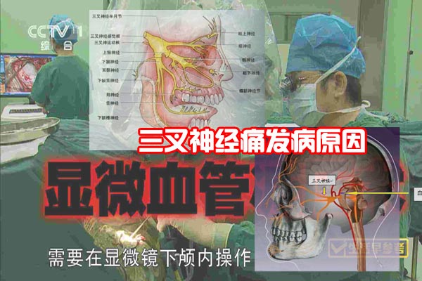 三叉神经痛发病-1.jpg