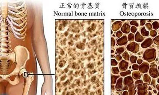 癫痫患者骨质疏松1.jpg