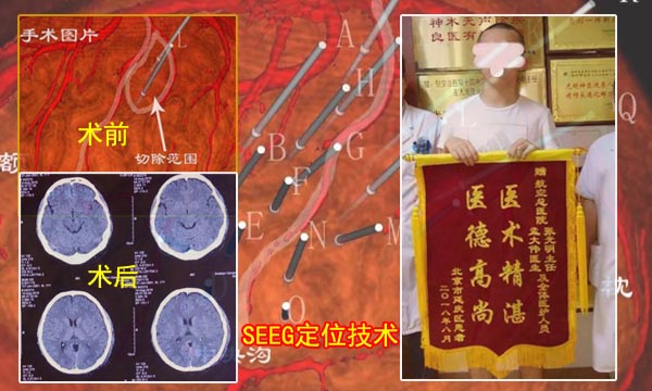 SEEG��λ�������-1.jpg