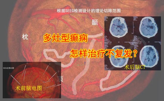 1545038932864218.jpg 1¶àÔîñ²ðïÊÖÊõ-1.jpg