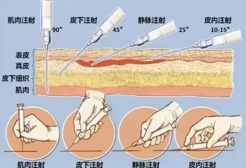 的静脉注射,除了治疗药物以外,其余成分主要是葡萄糖溶液或生理盐水