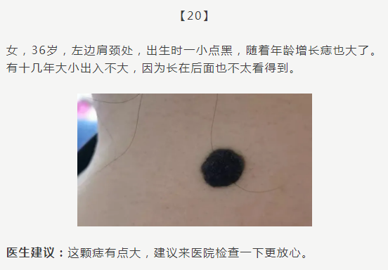 黑痣癌变,从发病到去世不到两个月!