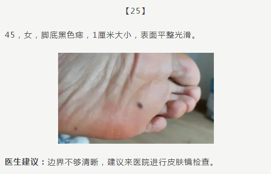 黑痣癌变,从发病到去世不到两个月!