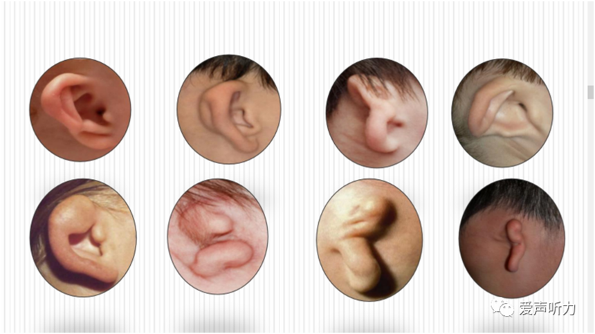 1691916561907327.png 畸形外耳.png