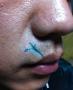 洗纹身疤痕：嘴角一次性祛除纹身