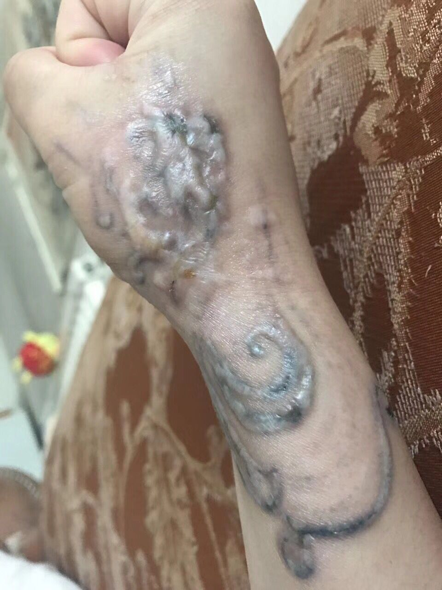 洗纹身疤痕安徽美女去除纹身增生疤痕记录第三次治疗恢复中图片视频