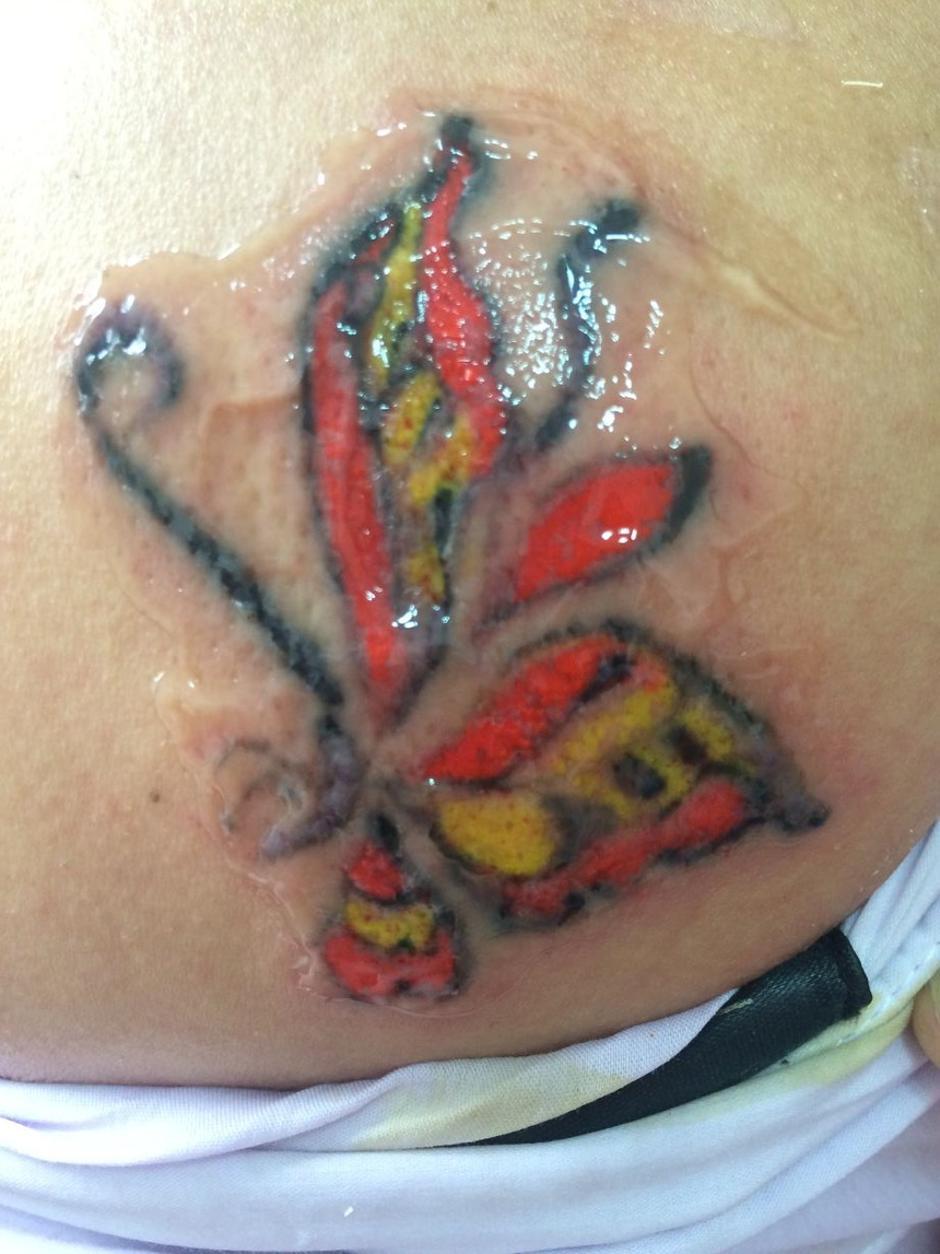 洗彩色纹身:洗纹身论坛重庆辣妈洗后背蝴蝶文身,第一次治疗恢复中图片