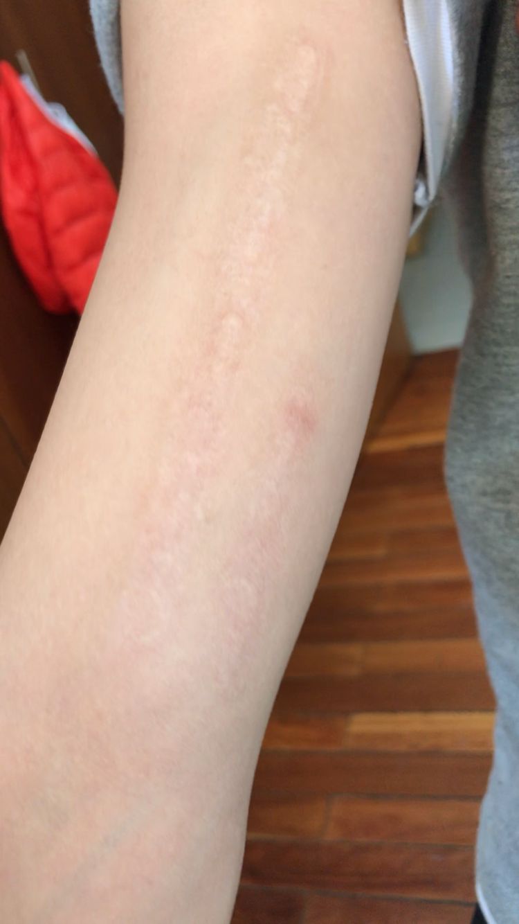 洗彩色纹身:泸西小孩祛除手臂大臂三处纹身记录,严禁给18岁以下小孩纹