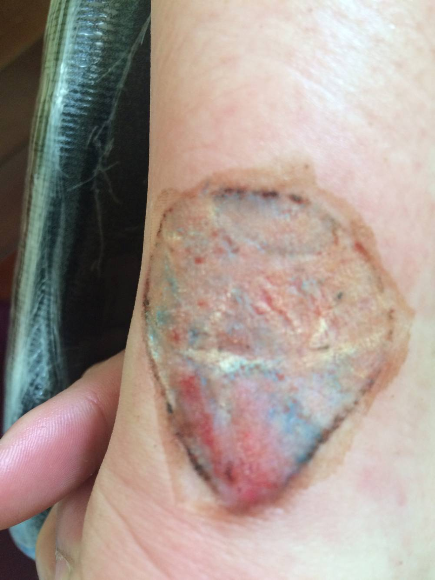 西双版纳女孩用药水在家治疗后发言起水泡特来我处修复,药水洗纹身