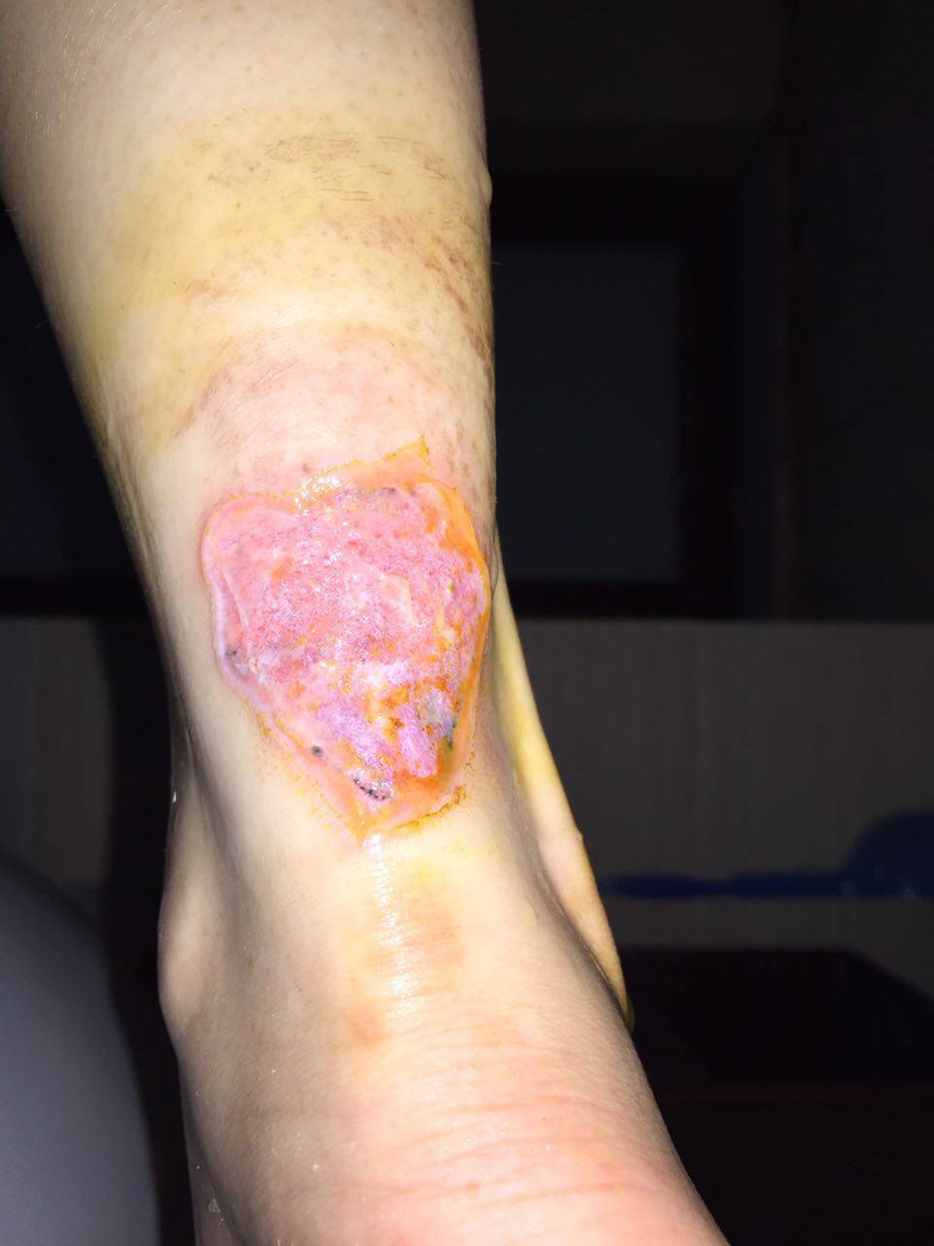 西双版纳女孩用药水在家治疗后发言起水泡特来我处修复,药水洗纹身