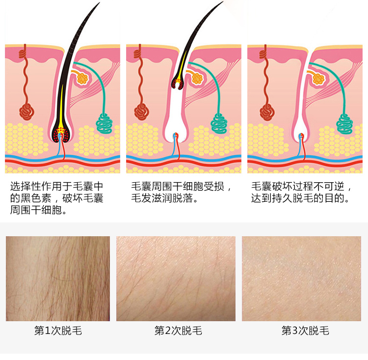 激光美容仪器|激光脱毛有用吗？