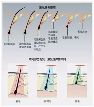 激光美容仪器的效果？激光脱毛有哪些问题的存在？