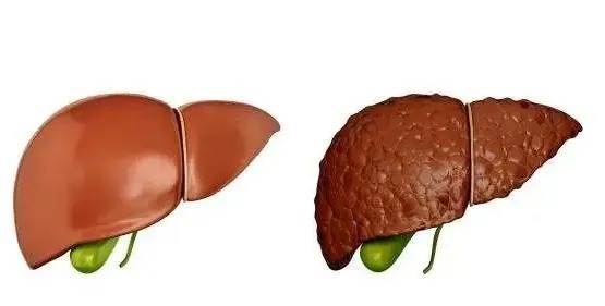 身上蜘蛛痣,警惕可能患有肝硬化