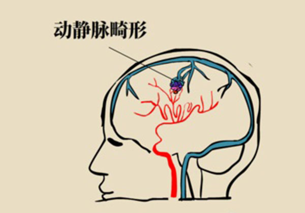 脑血管畸形1.jpg