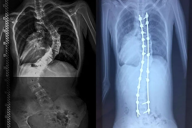 重度脊柱畸形手术矫正.jpg