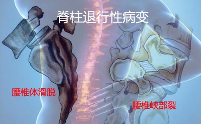 腰椎间盘滑脱.jpg