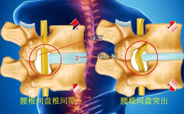 腰椎间盘突出.jpg