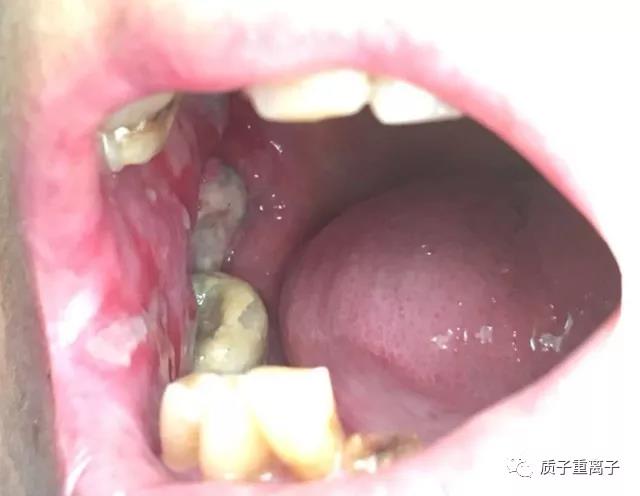 牙龈癌6.jpg