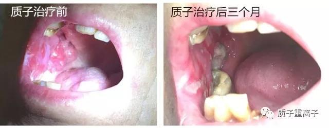 牙龈癌7.jpg