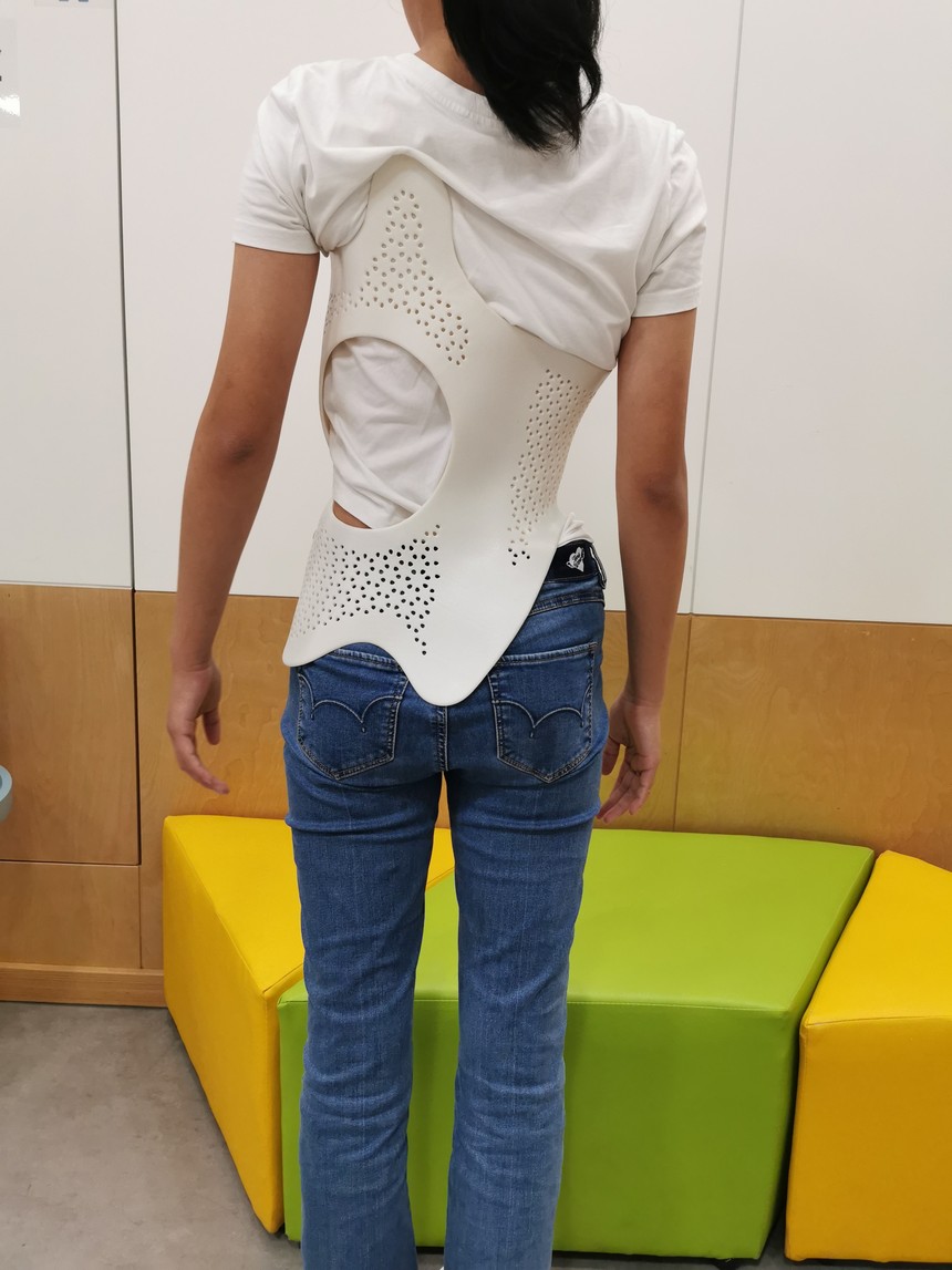 scs脊柱侧弯矫形器