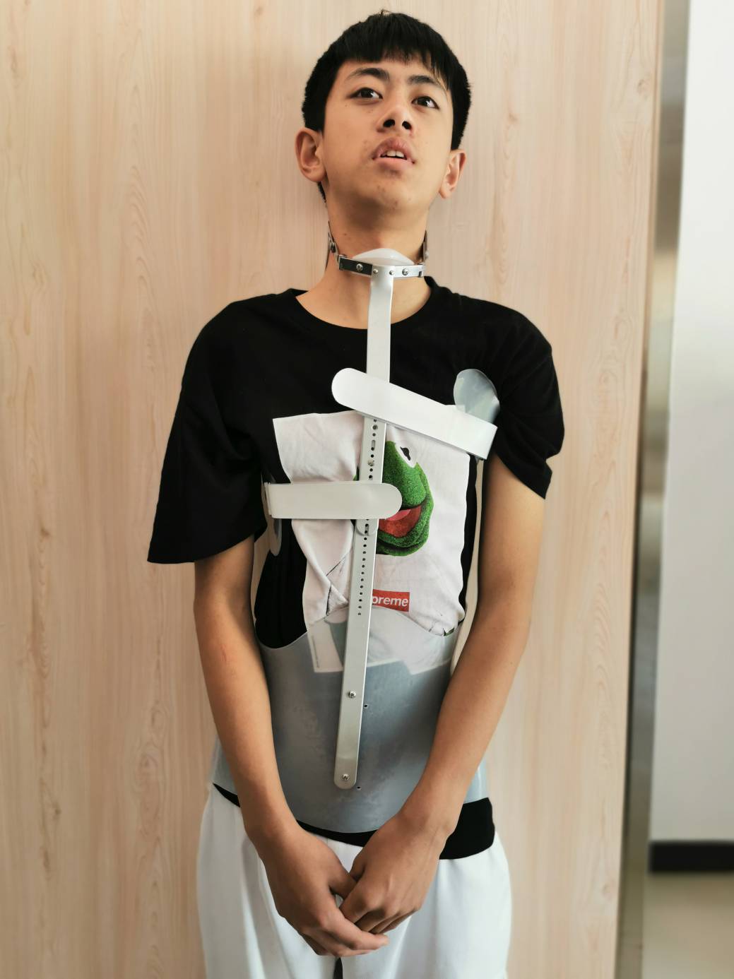 scs脊柱侧弯矫形器