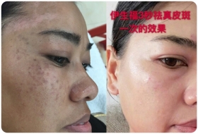 雀斑前后对比图雀斑前后对比图真皮斑前后对比图真皮斑前后对比图老年