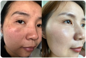 真皮斑前后对比图