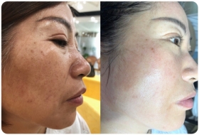 雀斑前后对比图