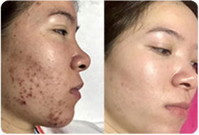 痘坑痘印前后对比图